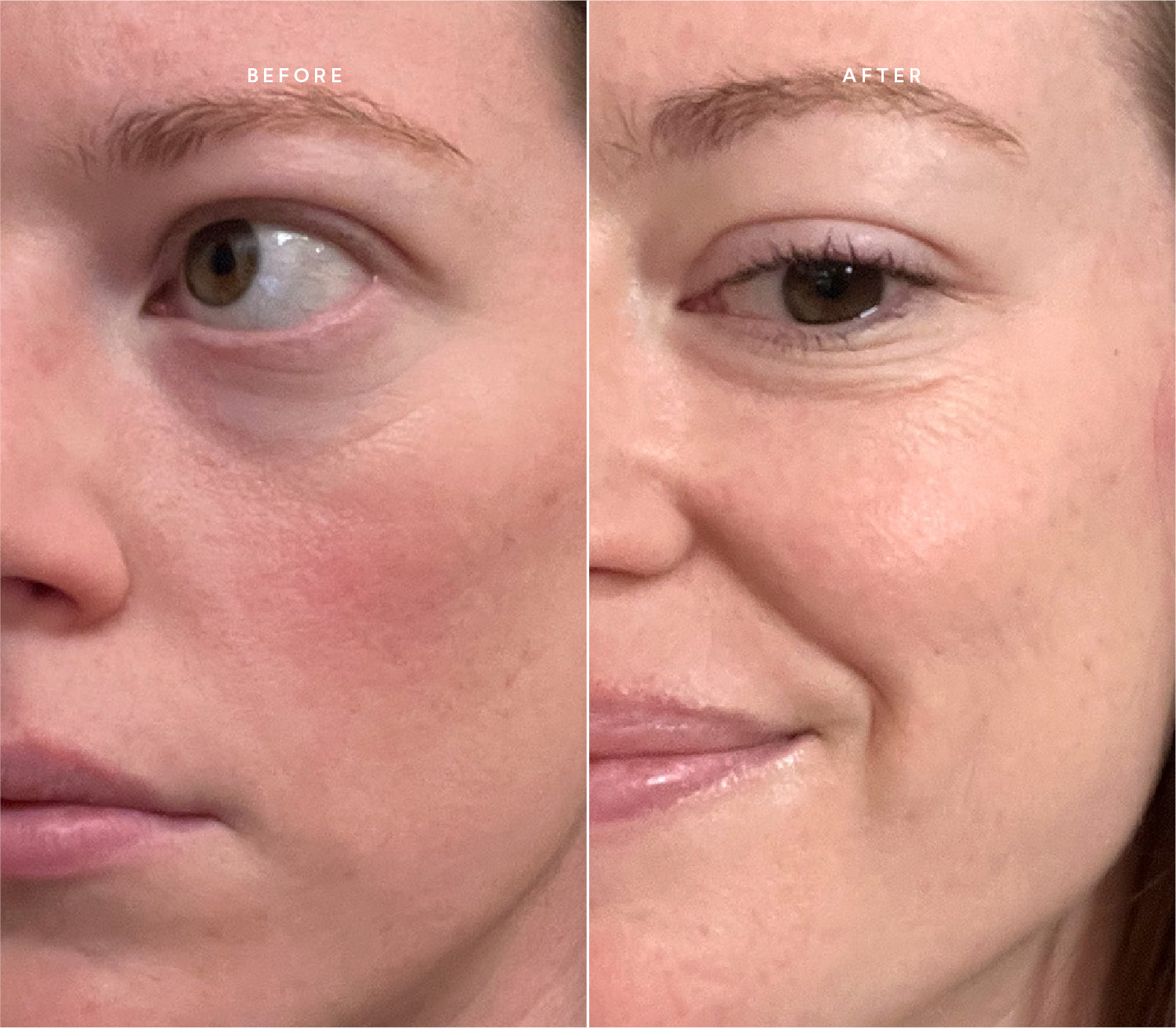 Before and after comparison showing improved skin texture and reduced blemishes.