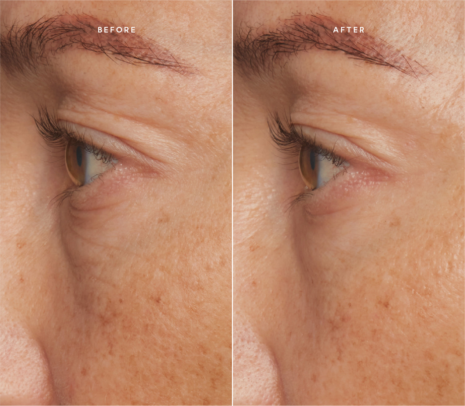 Before and after comparison showing smoother skin texture and reduced fine lines around the eye area.