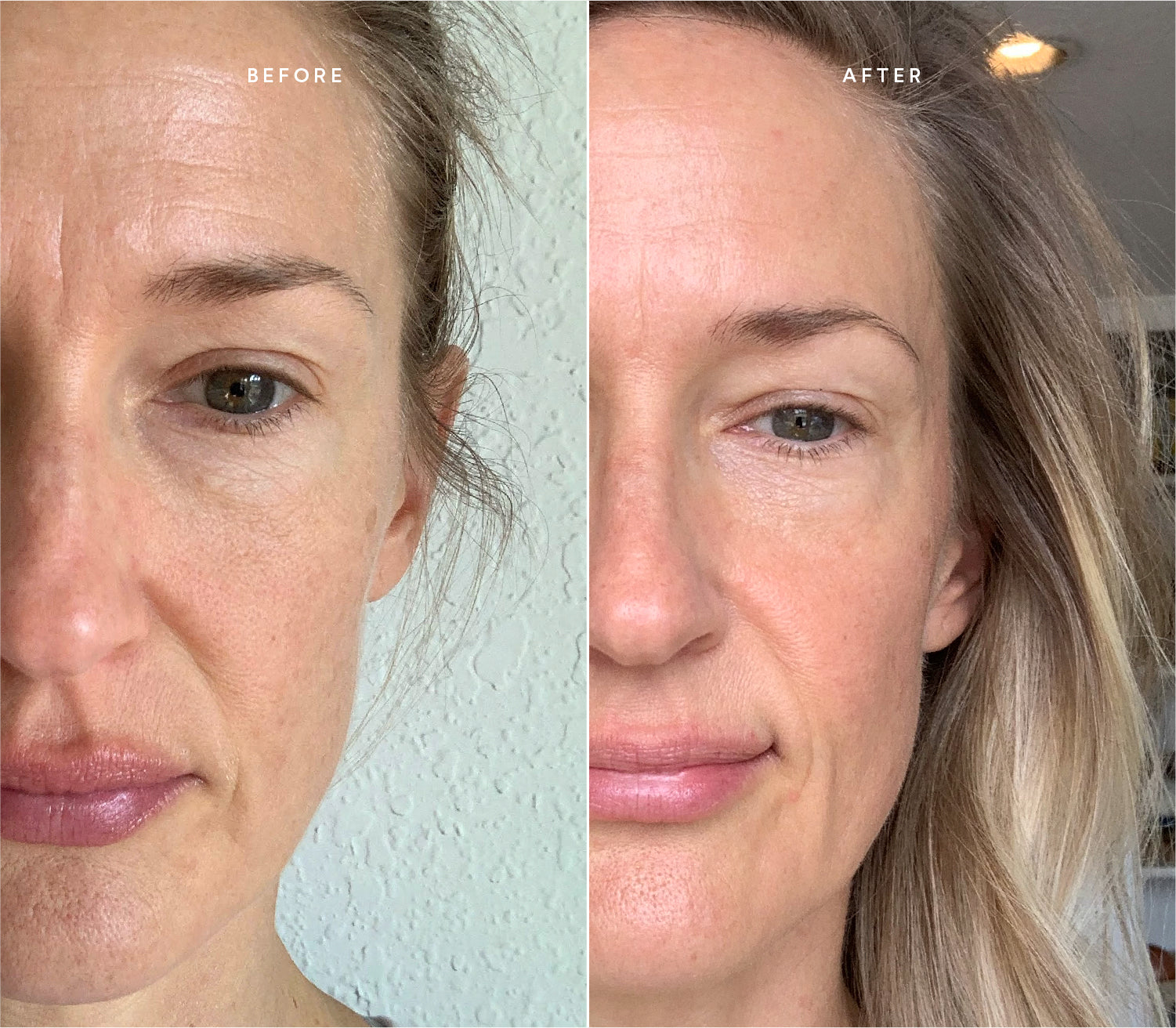 Before and after comparison showing improved skin texture and reduced blemishes.