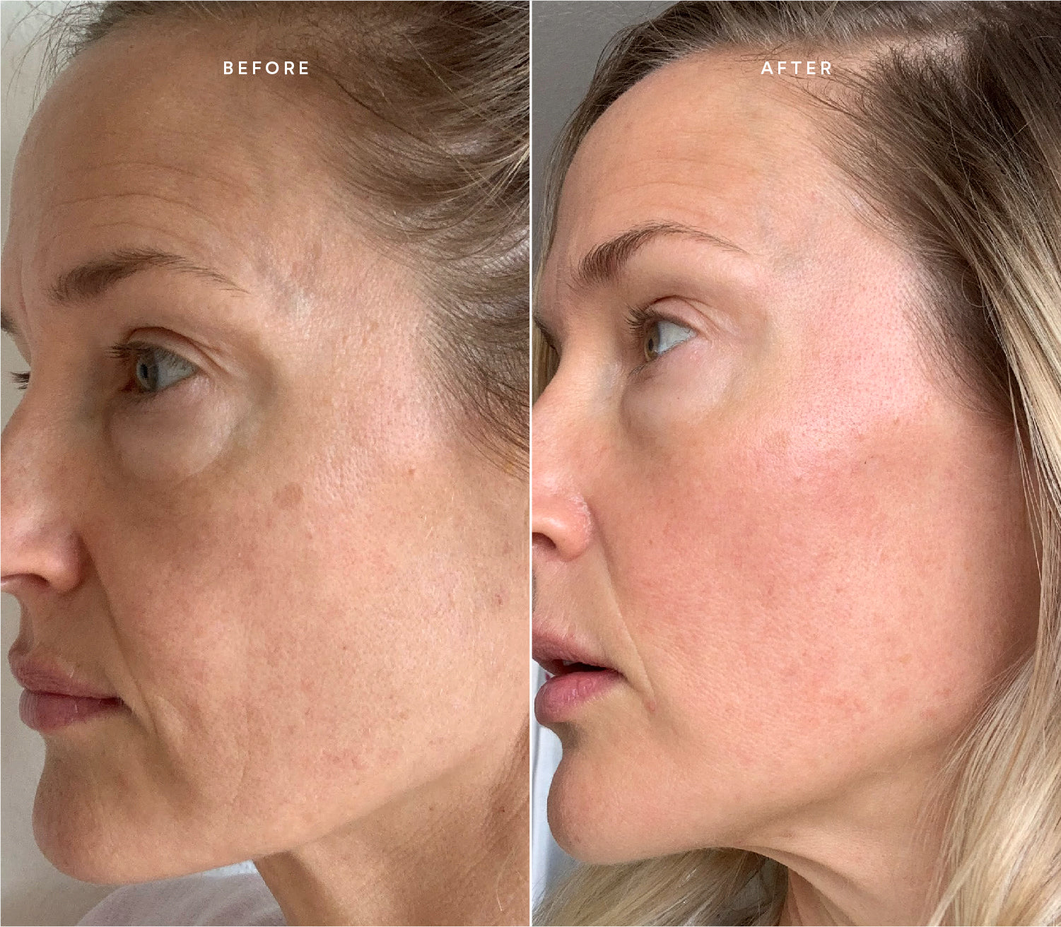 Before and after comparison showing improved skin texture and reduced blemishes.