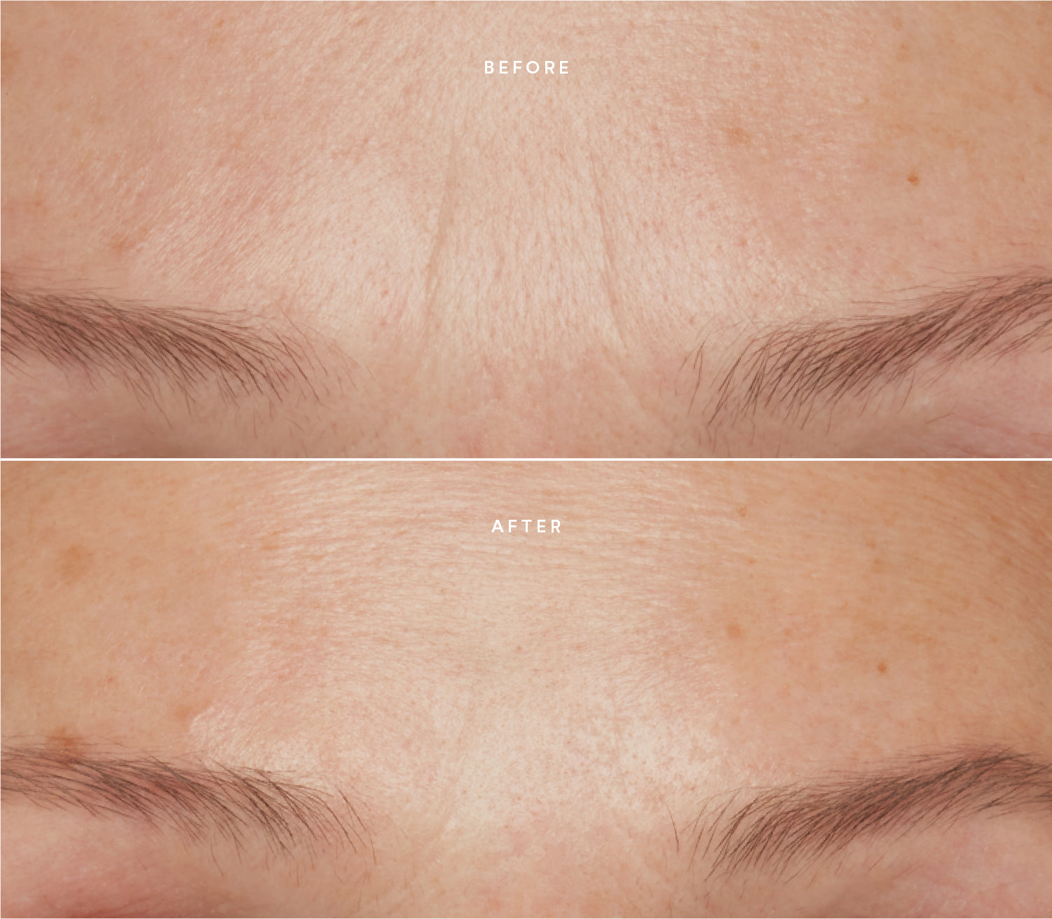 Before and after comparison showing improved skin texture.