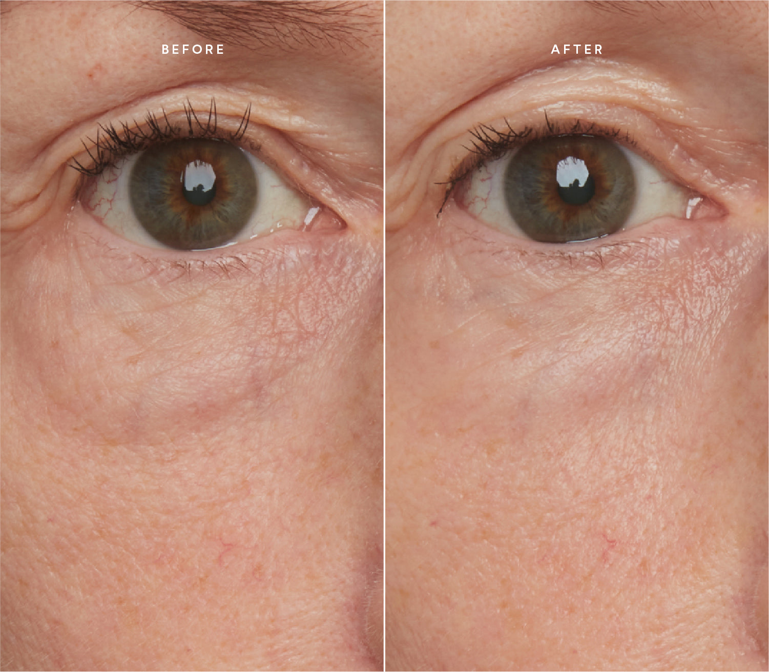 Before and after comparison showing smoother skin texture and reduced fine lines around the eye area.