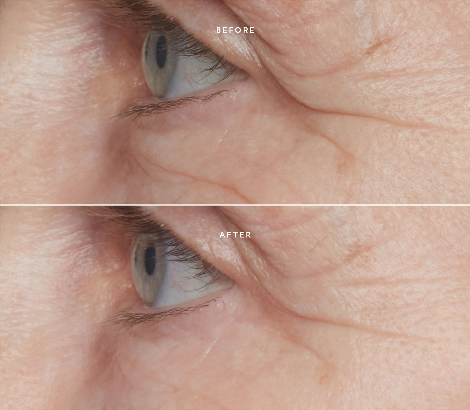 Before and after comparison showing smoother skin texture and reduced fine lines around the eye area.