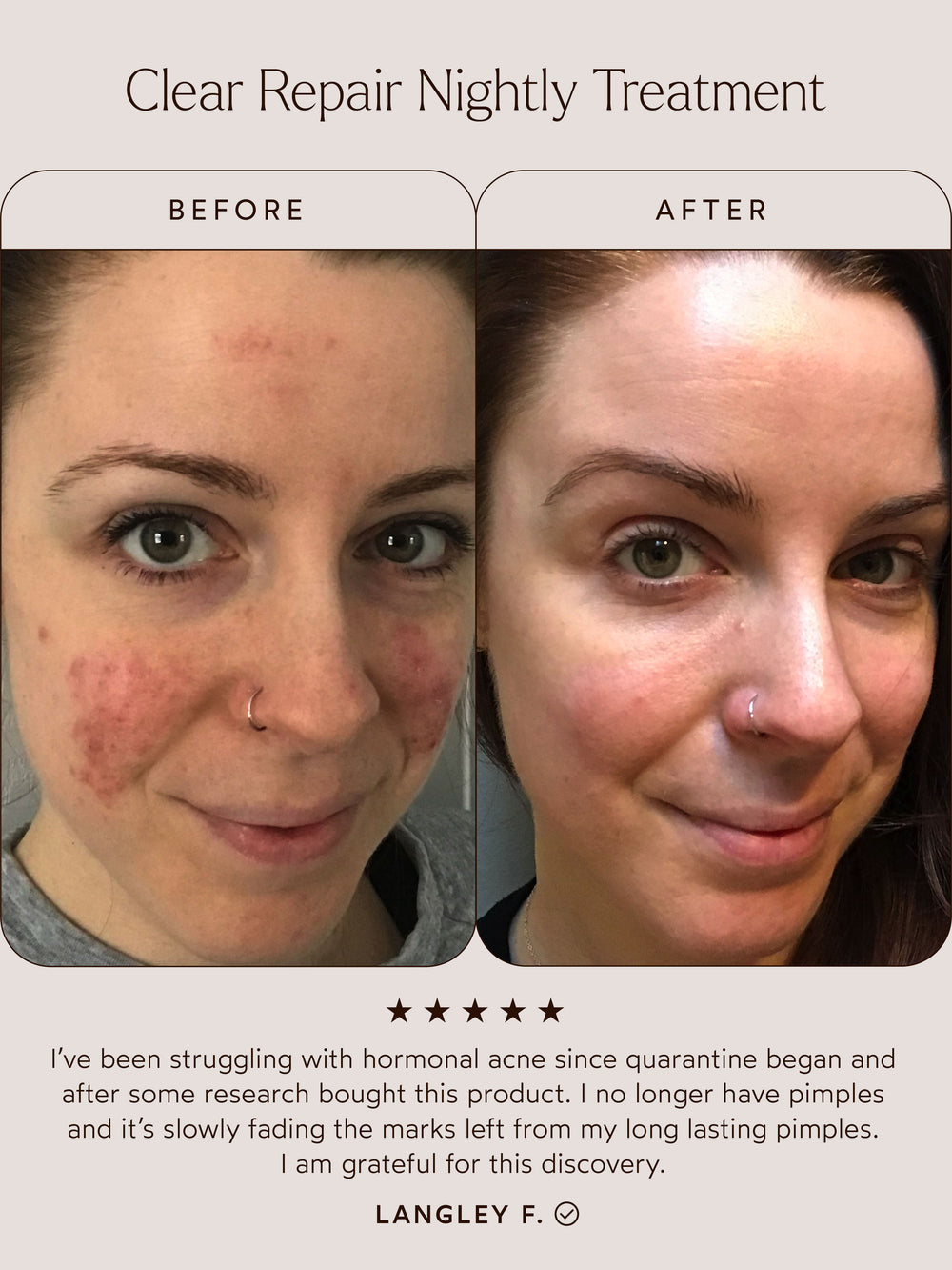 This image showcases the Clear Repair Nightly Treatment with a before-and-after transformation. The testimonial highlights clear, smooth skin, reduced acne marks, and a five-star review praising its results.