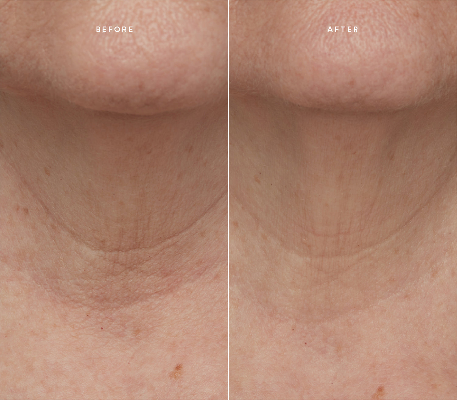 Before and after comparison showing smoother skin texture and reduced fine lines around the neck area.