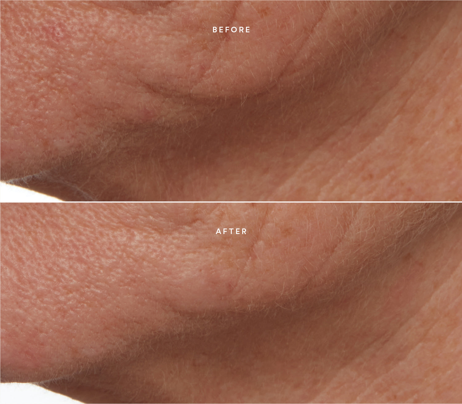 Before and after comparison showing improved skin texture and reduced wrinkles.