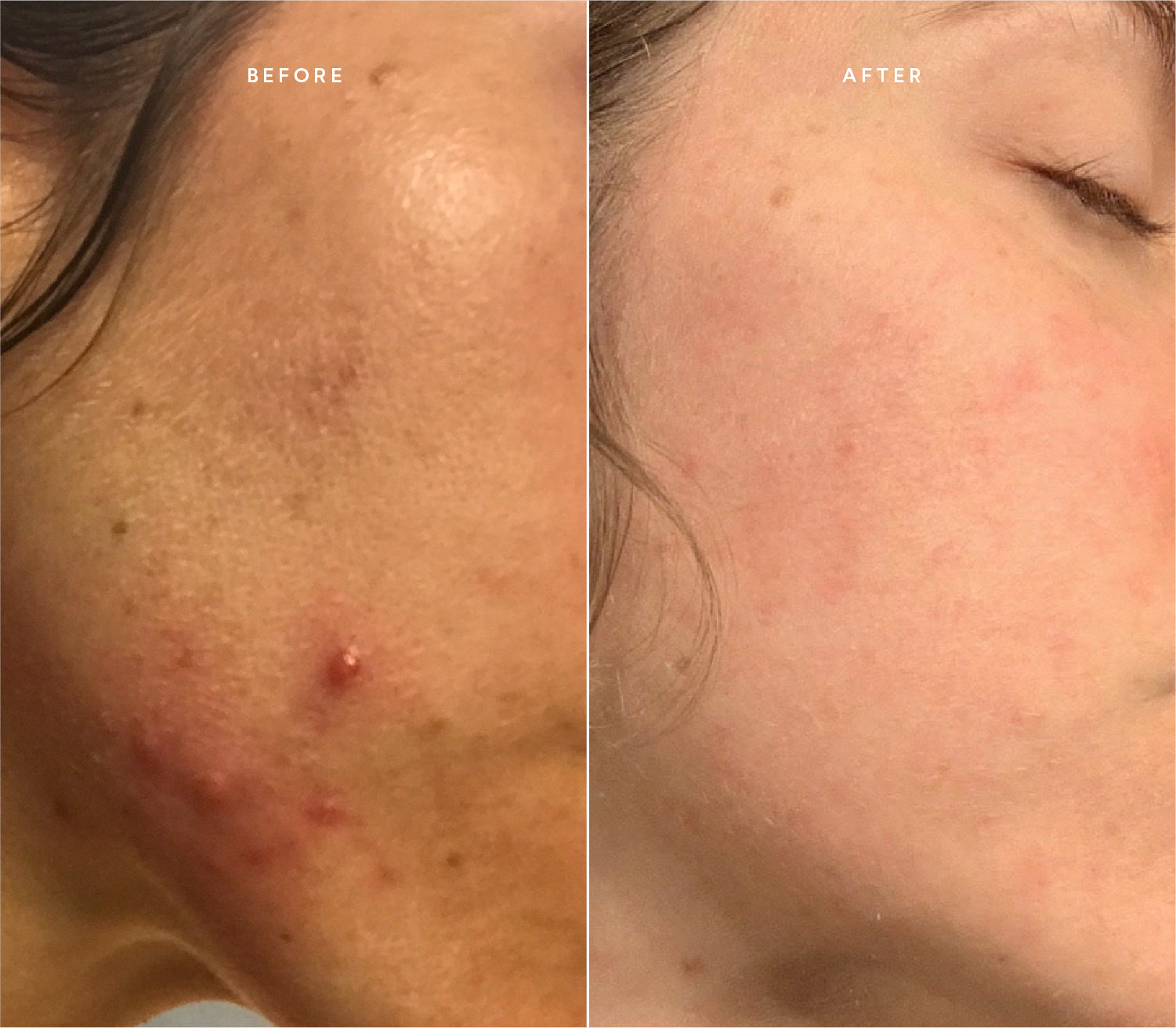 Before and after comparison showing reduced breakouts and a calmer, more even skin tone.