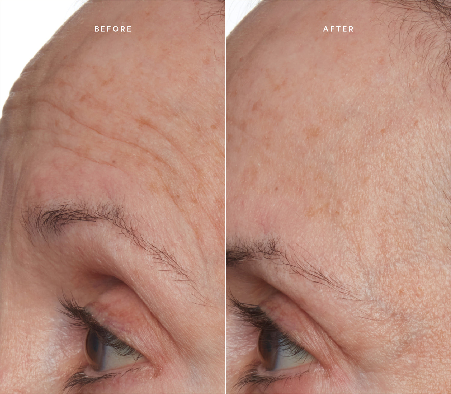 Before and after comparison showing improved skin texture and reduced wrinkles.