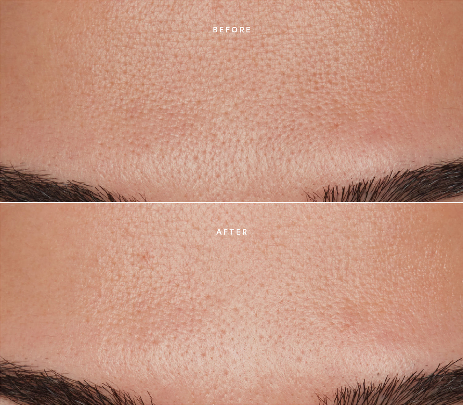 Before and after comparison showing  a calmer, more even skin tone with less pores.