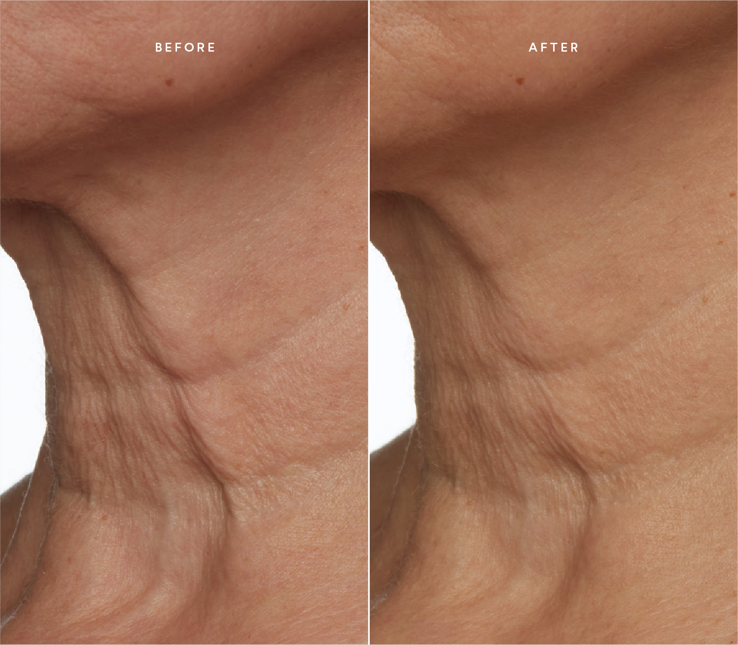 Before and after comparison showing improved skin texture and reduced sagginness on the neck.