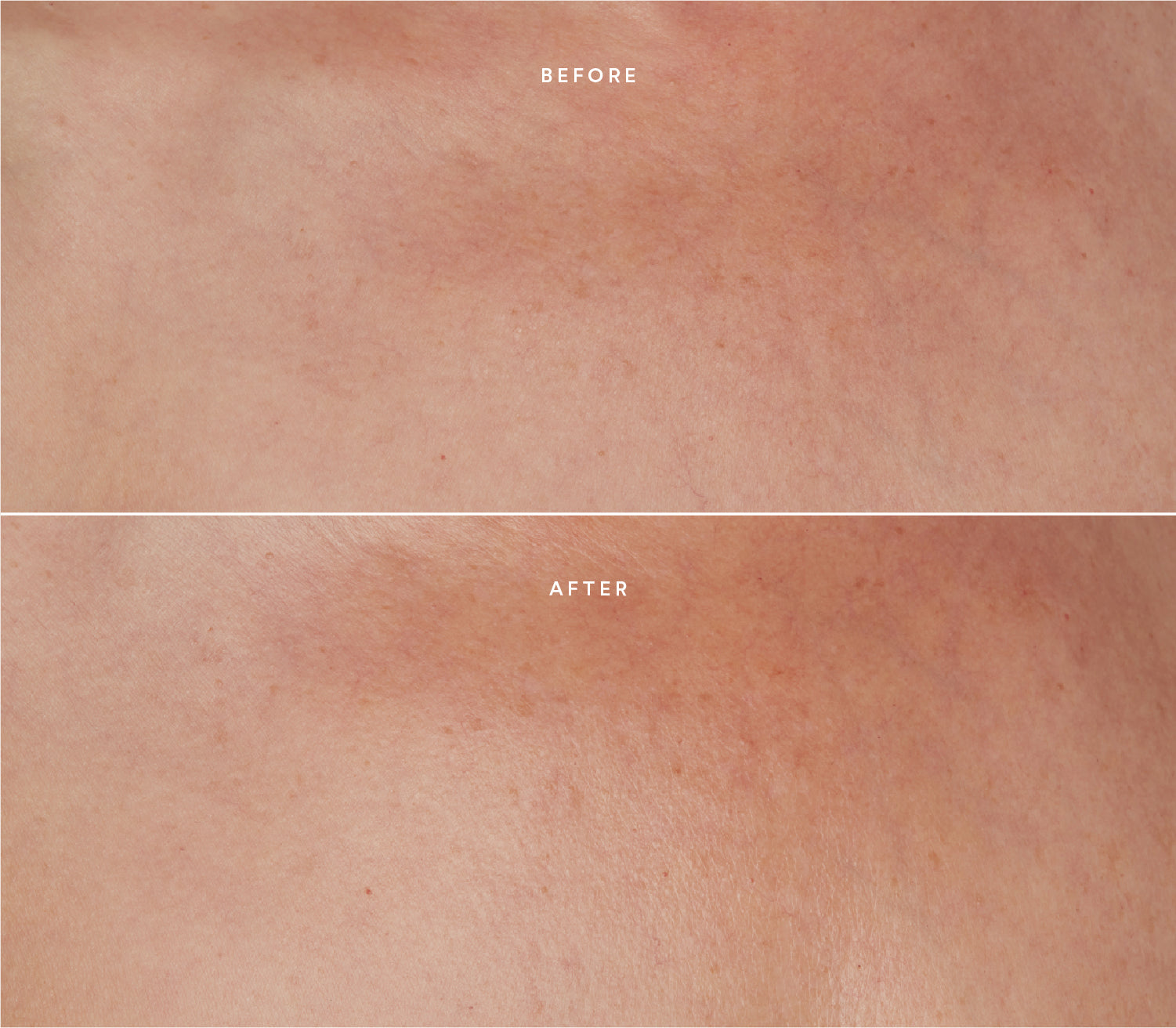 Before and after comparison showing improved skin texture.