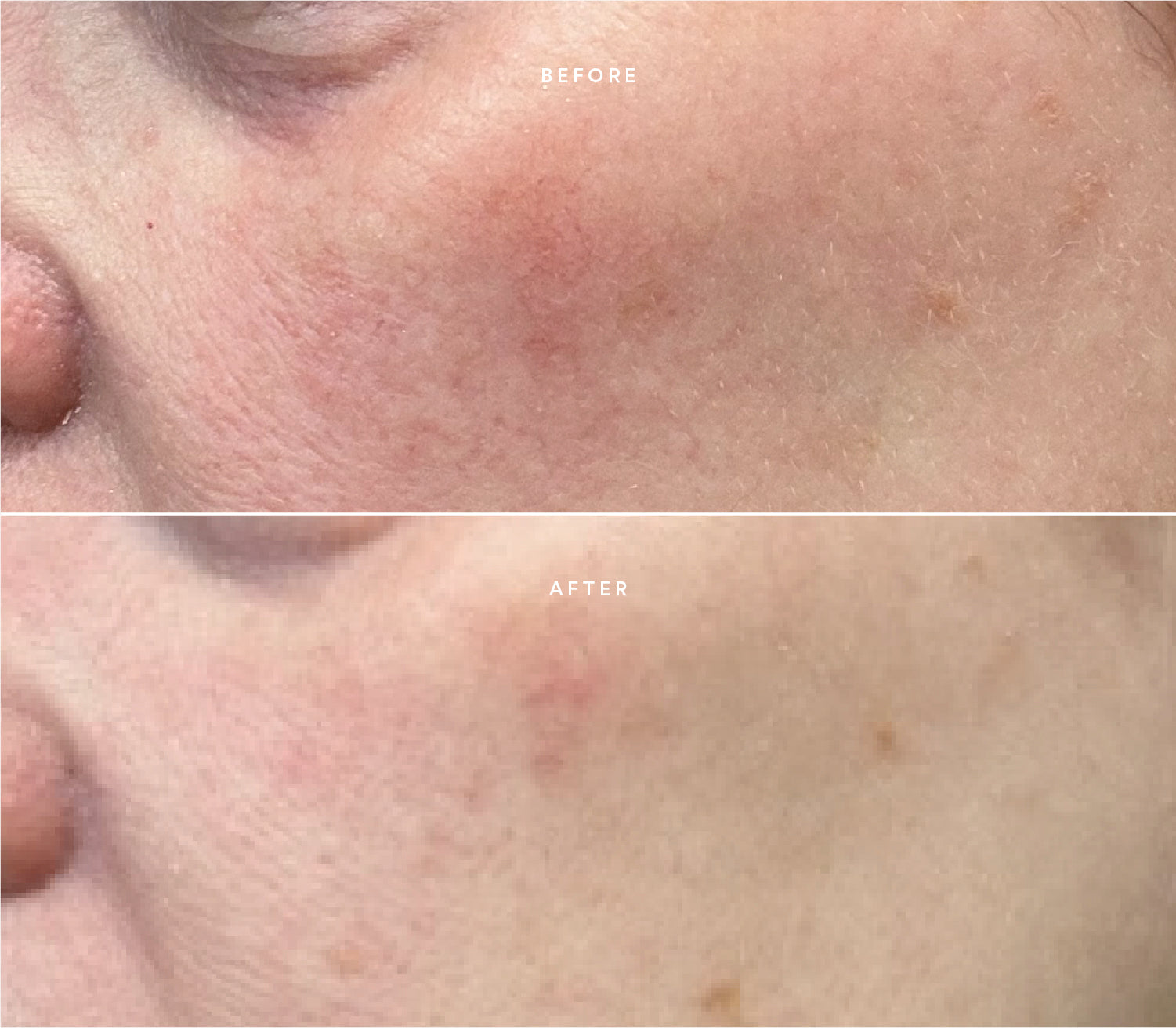 Before and after comparison showing improved skin texture and reduced blemishes.