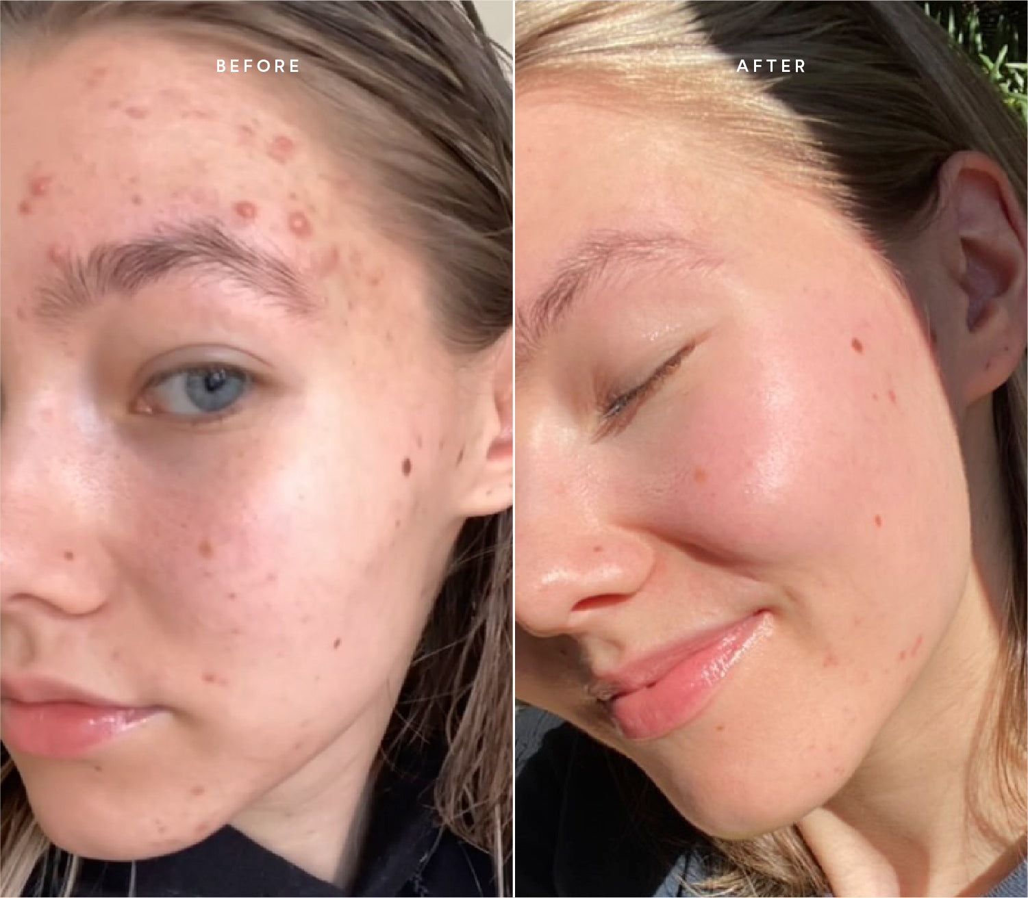 Before and after comparison showing reduced breakouts and a calmer, more even skin tone.