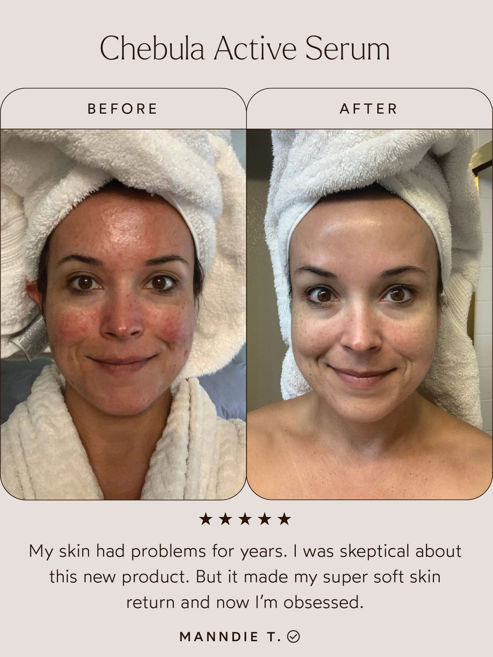 Before and after comparison of a woman's skin using Chebula Active Serum. The "Before" image shows redness, blemishes, and uneven skin tone, while the "After" image reveals smoother, clearer, and more radiant skin. Below the images, a testimonial reads: "My skin had problems for years. I was skeptical about this new product. But it made my super soft skin return and now I’m obsessed." – Manndie T.