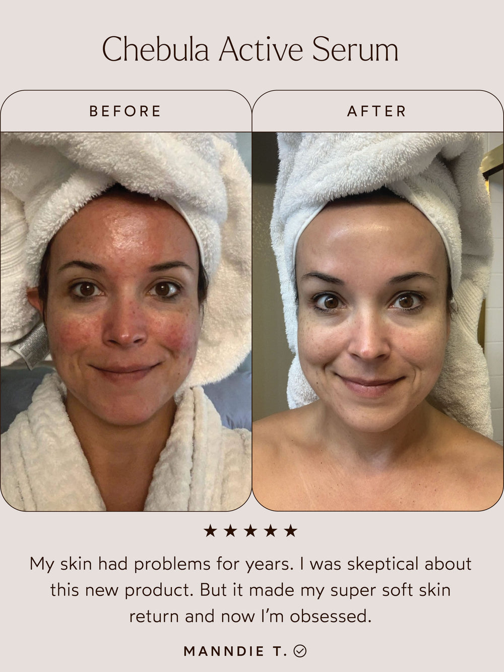 Before and after comparison of a woman's face with Chebula Active Serum, showing improved skin texture.