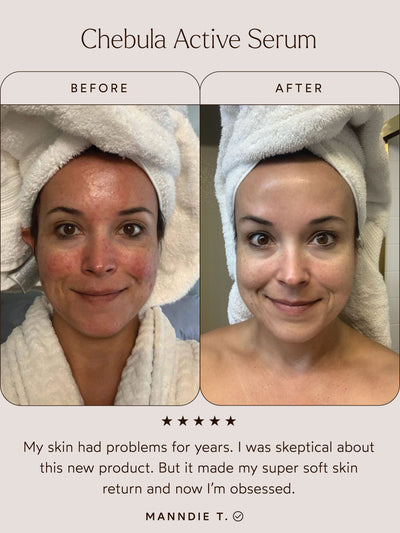Before and after comparison of a woman's face with Chebula Active Serum, showing improved skin texture.