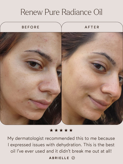 Before and after comparison of a woman’s skin using Renew Pure Radiance Oil. The "Before" image shows dehydrated skin with visible blemishes, while the "After" image reveals smoother, more hydrated, and even-toned skin. Below the images, a testimonial reads: "My dermatologist recommended this to me because I expressed issues with dehydration. This is the best oil I’ve ever used and it didn’t break me out at all!" – Abrielle.