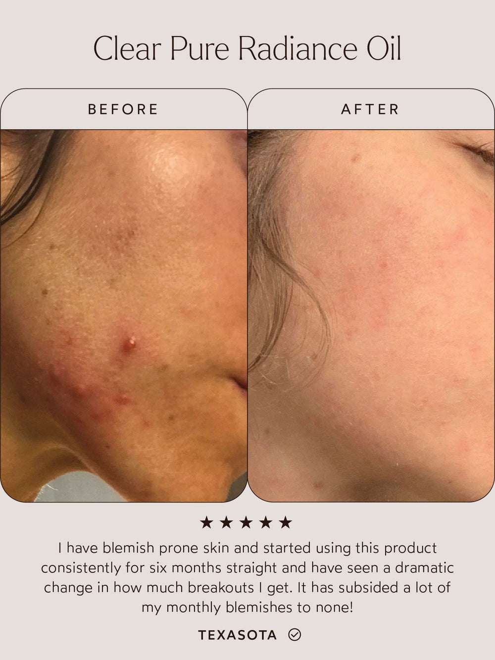 Before and after comparison of a user’s skin using Clear Pure Radiance Oil. The left image shows blemish-prone skin with visible redness and breakouts, while the right image shows significantly clearer and smoother skin. Below the images, a testimonial reads: "I have blemish-prone skin and started using this product consistently for six months straight and have seen a dramatic change in how much breakouts I get. It has subsided a lot of my monthly blemishes to none!" – Texasota.