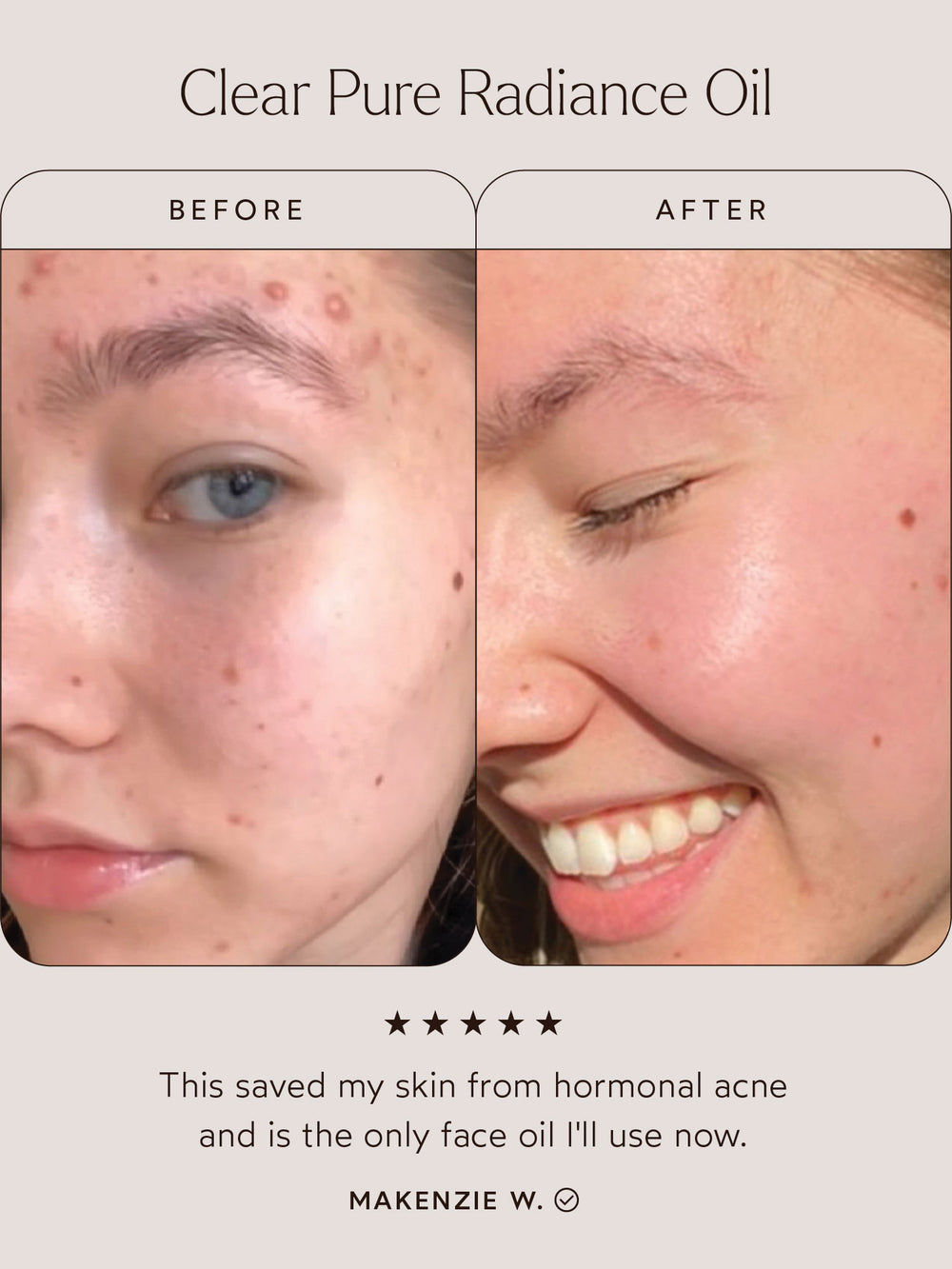 Before and after comparison of a young woman using Clear Pure Radiance Oil. The left image shows the skin with visible hormonal acne and redness, while the right image reveals clear, glowing, and smooth skin. Below the images, a testimonial reads: This saved my skin from hormonal acne and is the only face oil I'll use now. – Makenzie W.