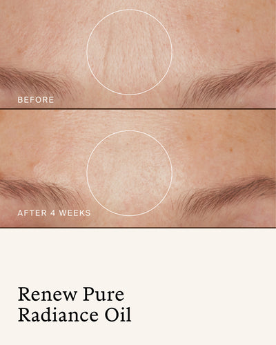Before-and-after close-up showing the appearance of forehead fine lines before and after 4 weeks of using True Botanicals Renew Pure Radiance Oil.