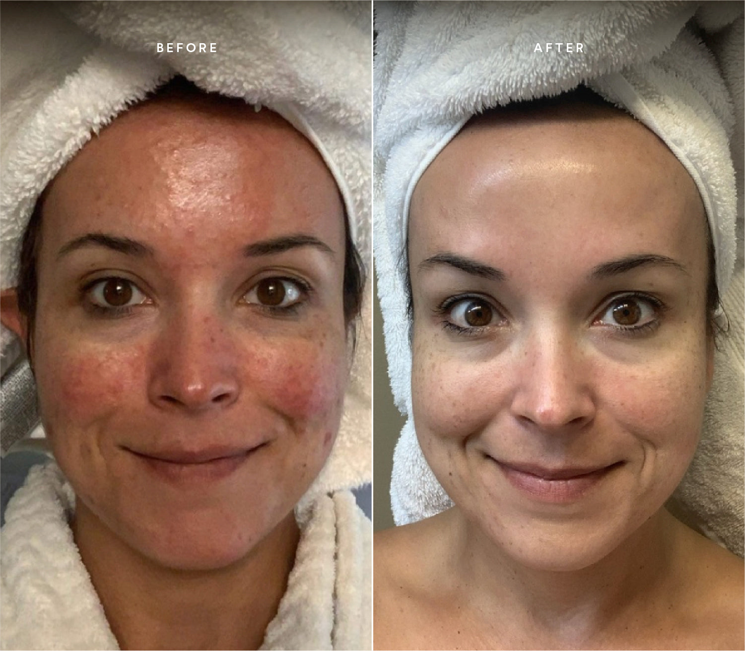 Before and after comparison showing improved skin texture and reduced blemishes.